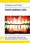 Tooth Surface Loss